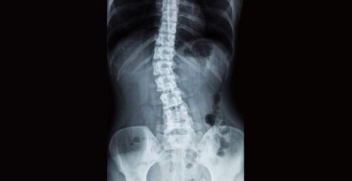 MÉTODO PILATES: EJERCICIOS APLICADOS A POBLACIONES ESPECIALES (EMBARAZO, PRE-POST PARTO Y ESCOLIOSIS) - Imagen 6