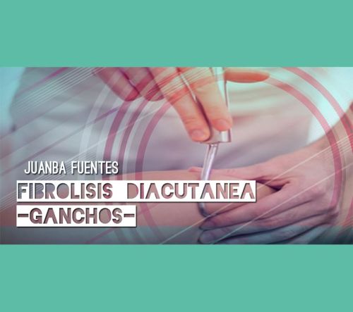 FIBRÓLISIS DIACUTÁNEA (GANCHOS): tratamiento neuromusculoesquelético Junio (Valencia)