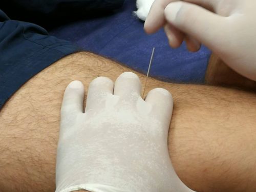 Curso de Punción Seca y Electropunción Las Palmas - Aplicada a Patología Clínica <h2>Las Palmas - 15 y 16 de marzo </h2> - Imagen 5